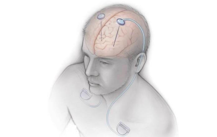 AIIMS conducts India’s 1st Deep Brain Stimulation workshop for Parkinson’s, movement disorders