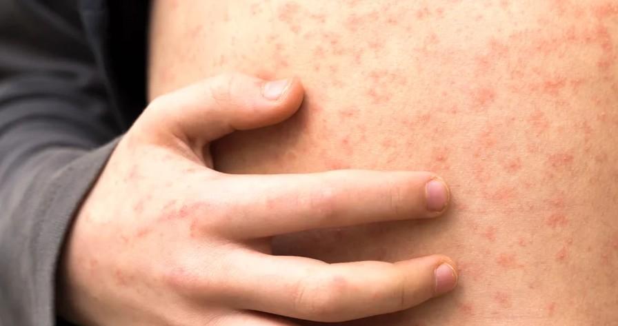 Second child dies of measles in Mongolia's capital