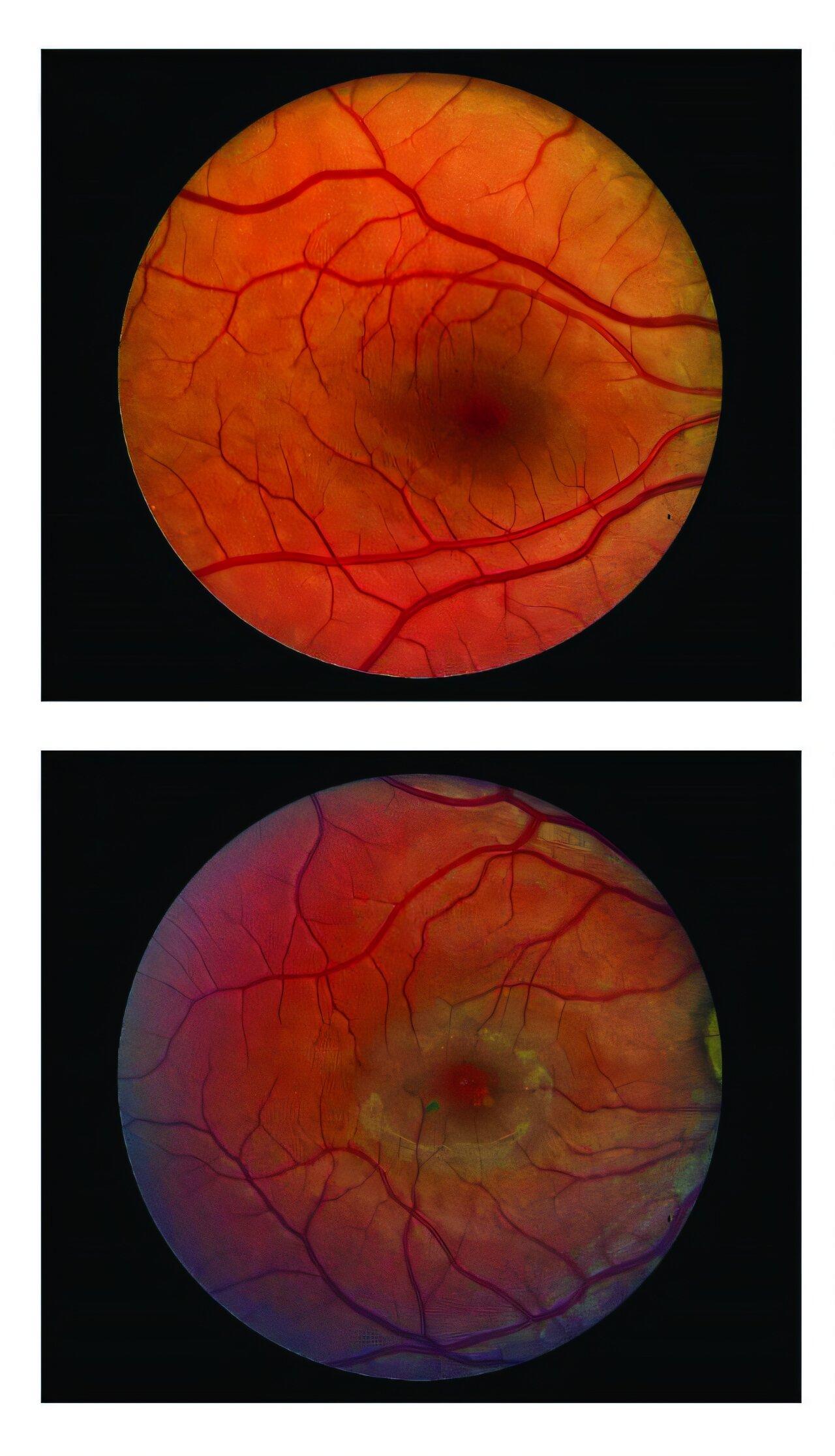 Surgical implant can slow down vision loss caused by blinding eye disease: Study