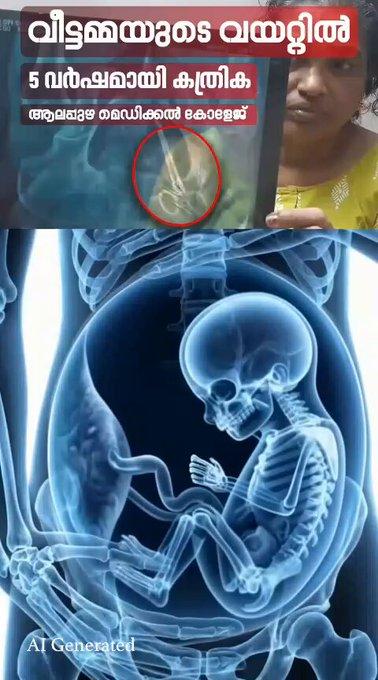 Cong leaders slam Vijayan govt over 'isolated incidents' claim in Kerala health sector