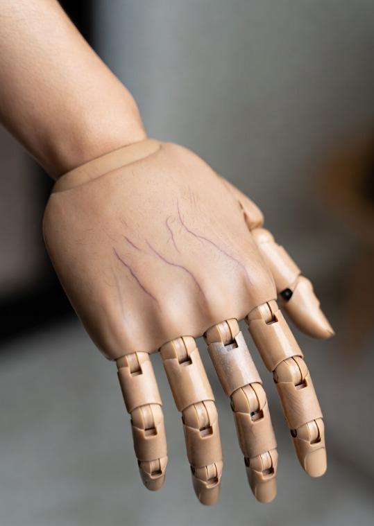 Waiting for ‘new arm’, Kerala's 9-year-old Vinodini holding on to her dream