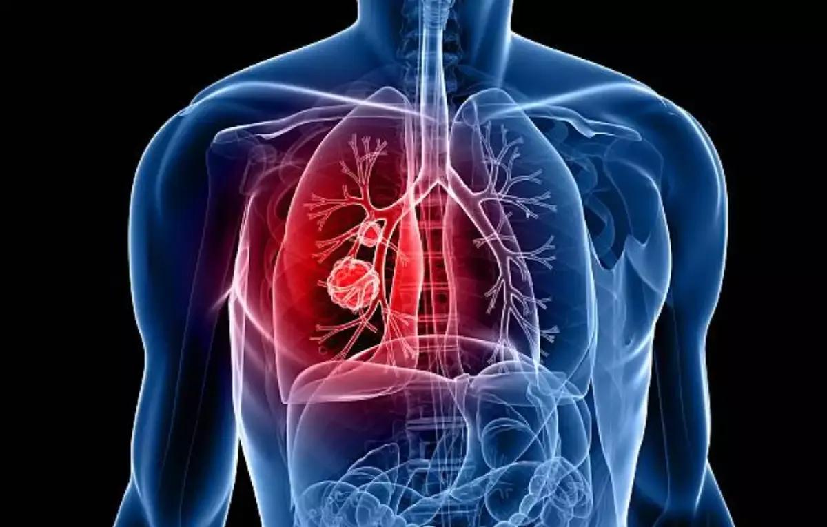 Lung Cancer Patients